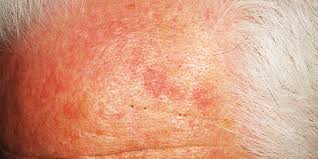 What is an AK (Actinic Keratosis)?