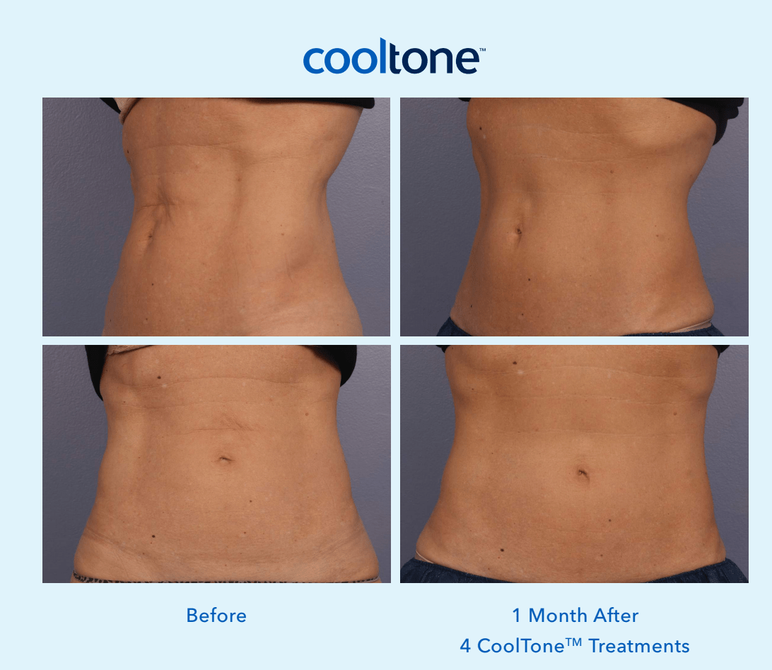 CoolTone® Muscle Toning, Fresno, CA